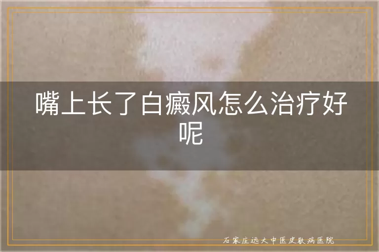 嘴上长了白癜风怎么治疗好呢