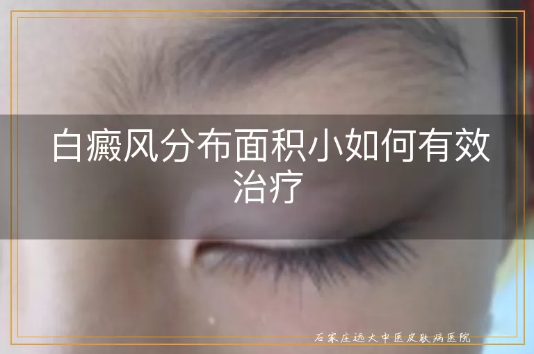 白癜风分布面积小如何有效治疗