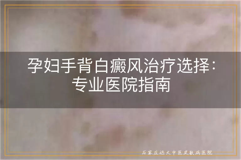 孕妇手背白癜风治疗选择：专业医院指南