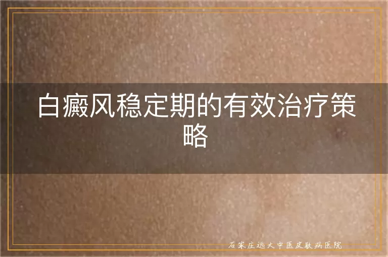 白癜风稳定期的有效治疗策略