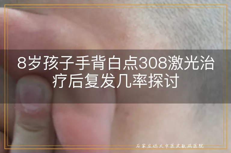 8岁孩子手背白点308激光治疗后复发几率探讨