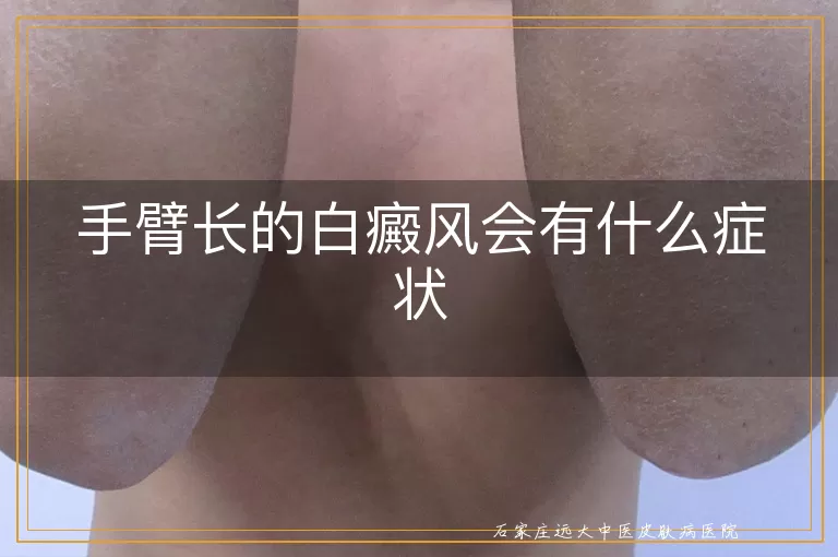 手臂长的白癜风会有什么症状
