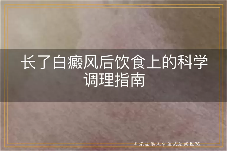 长了白癜风后饮食上的科学调理指南