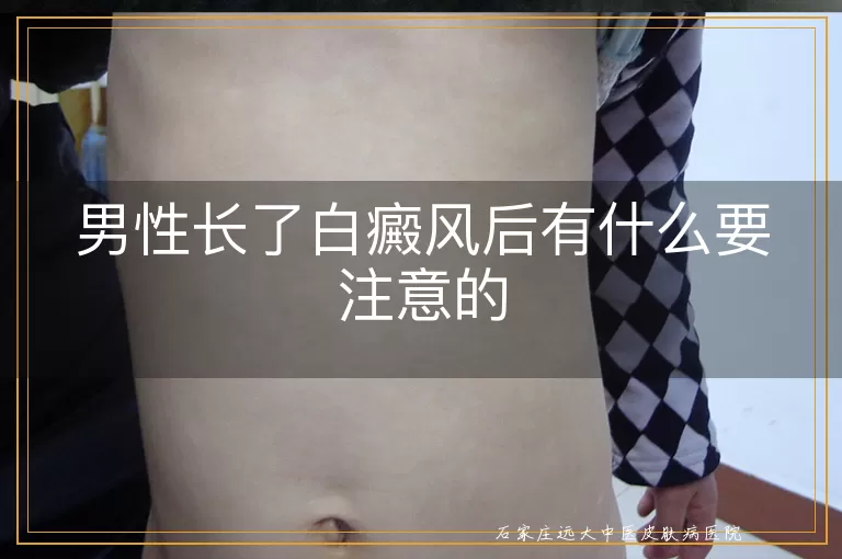 男性长了白癜风后有什么要注意的