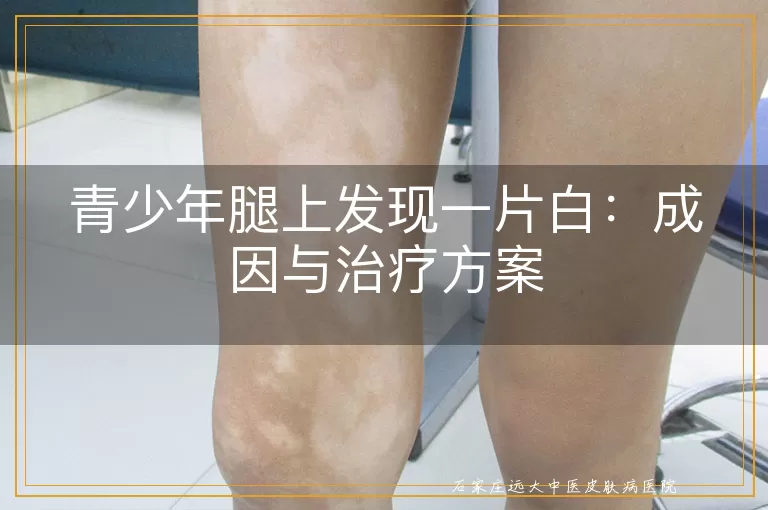 青少年腿上发现一片白：成因与治疗方案
