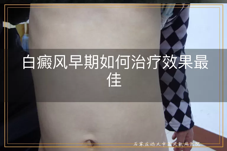 白癜风早期如何治疗效果最佳