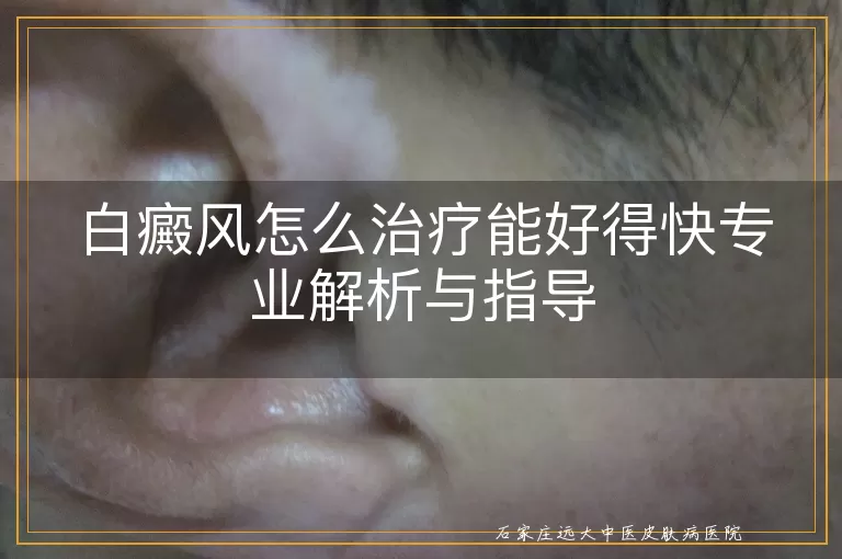 白癜风怎么治疗能好得快专业解析与指导