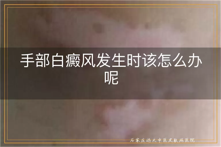 手部白癜风发生时该怎么办呢