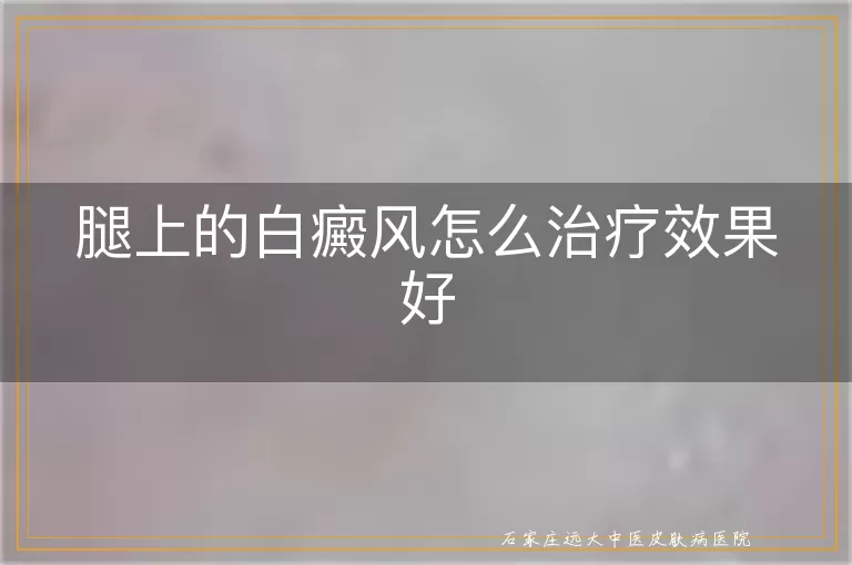 腿上的白癜风怎么治疗效果好