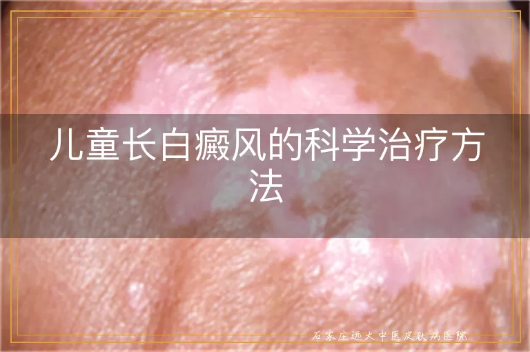 儿童长白癜风的科学治疗方法