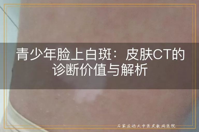 青少年脸上白斑：皮肤CT的诊断价值与解析