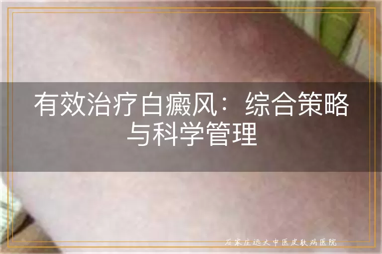 有效治疗白癜风：综合策略与科学管理