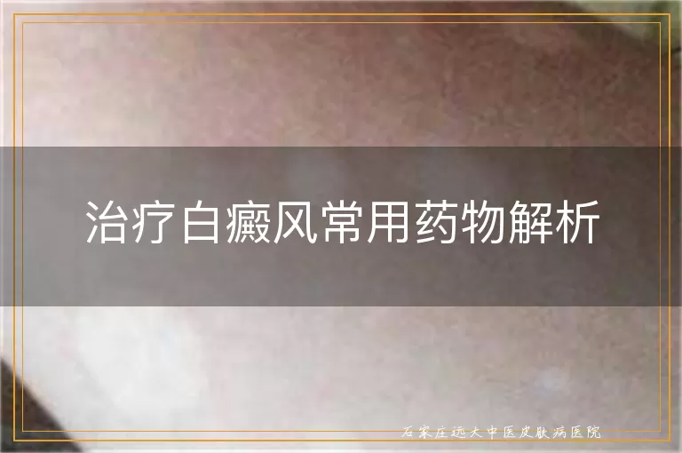 治疗白癜风常用药物解析