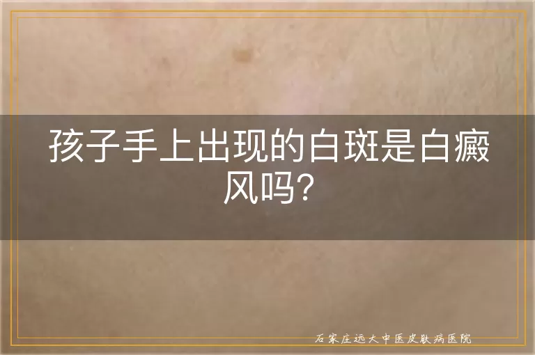 孩子手上出现的白斑是白癜风吗？