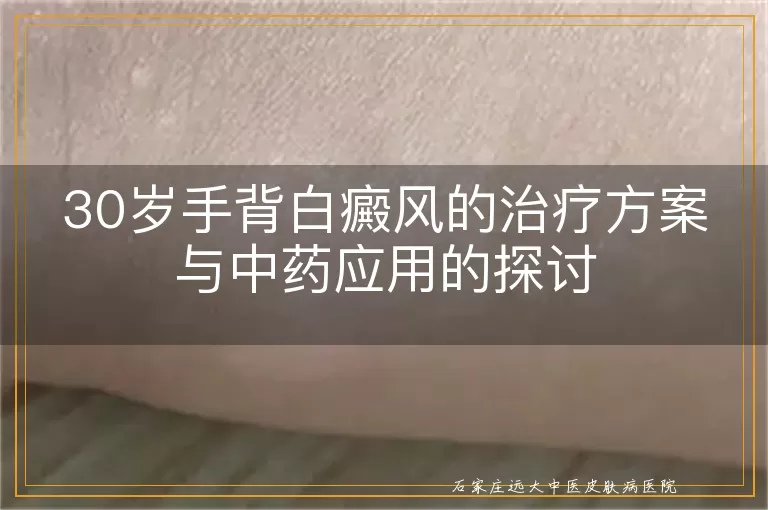 30岁手背白癜风的治疗方案与中药应用的探讨