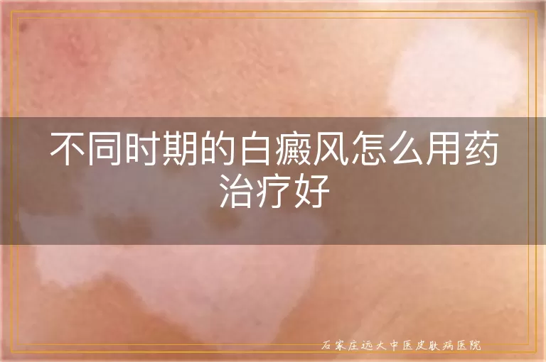 不同时期的白癜风怎么用药治疗好