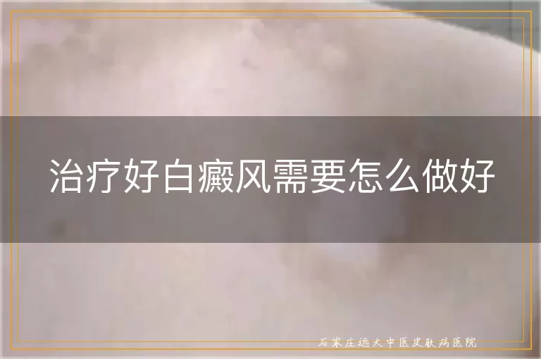 治疗好白癜风需要怎么做好