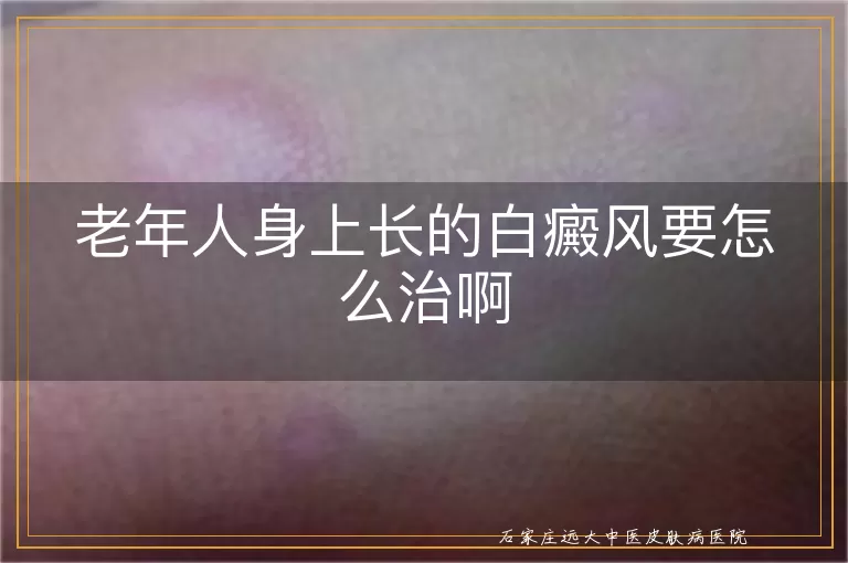 老年人身上长的白癜风要怎么治啊