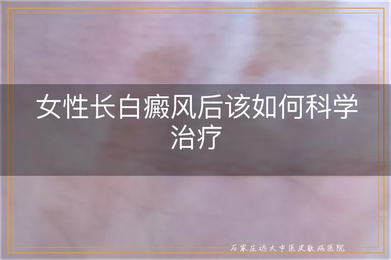 女性长白癜风后该如何科学治疗