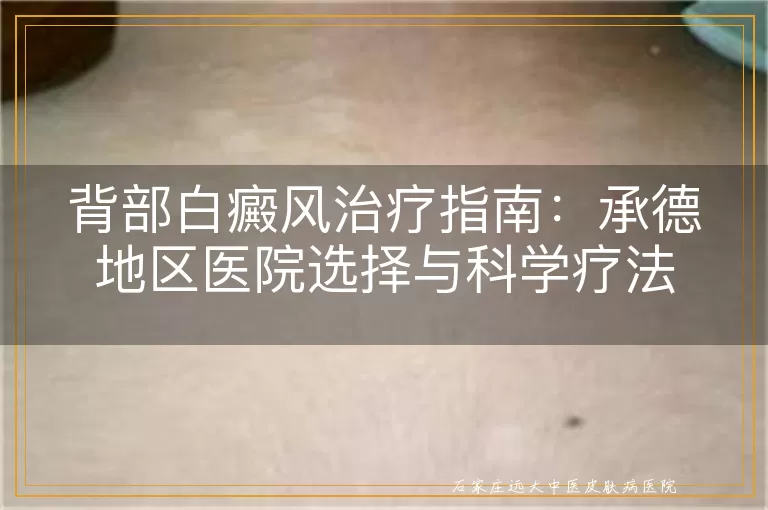 背部白癜风治疗指南：承德地区医院选择与科学疗法