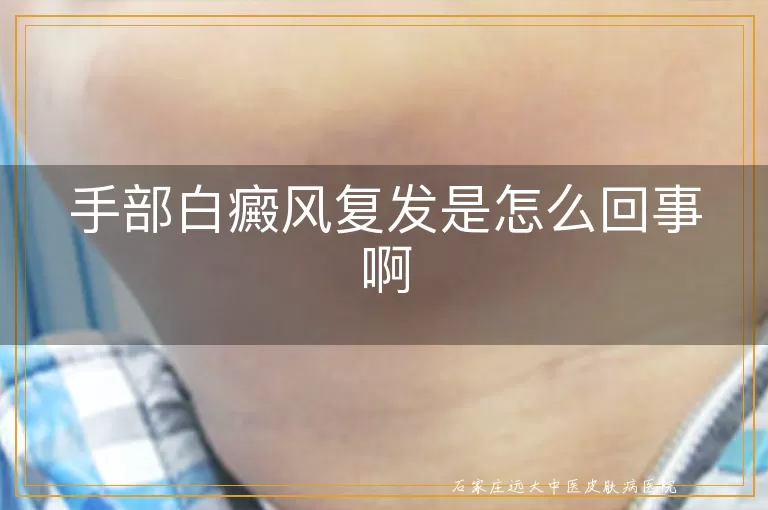 手部白癜风复发是怎么回事啊