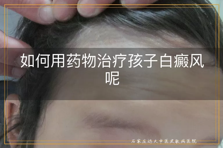 如何用药物治疗孩子白癜风呢