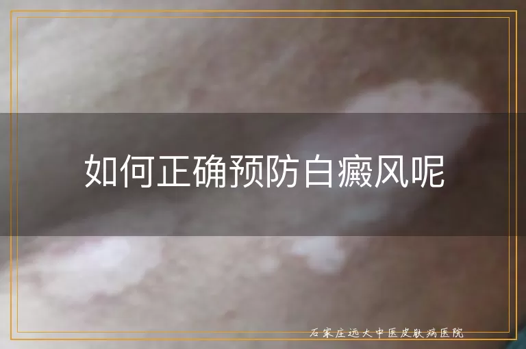 如何正确预防白癜风呢