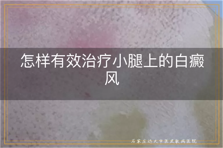 怎样有效治疗小腿上的白癜风