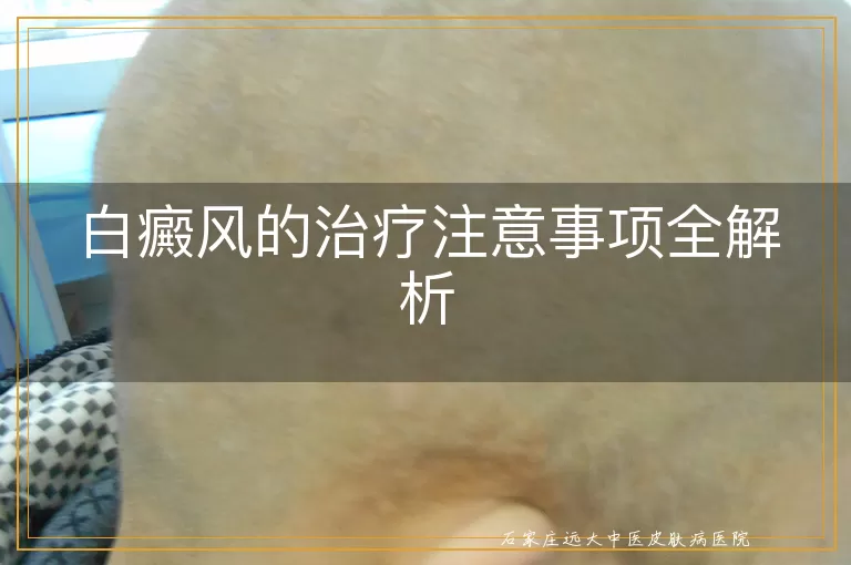 白癜风的治疗注意事项全解析