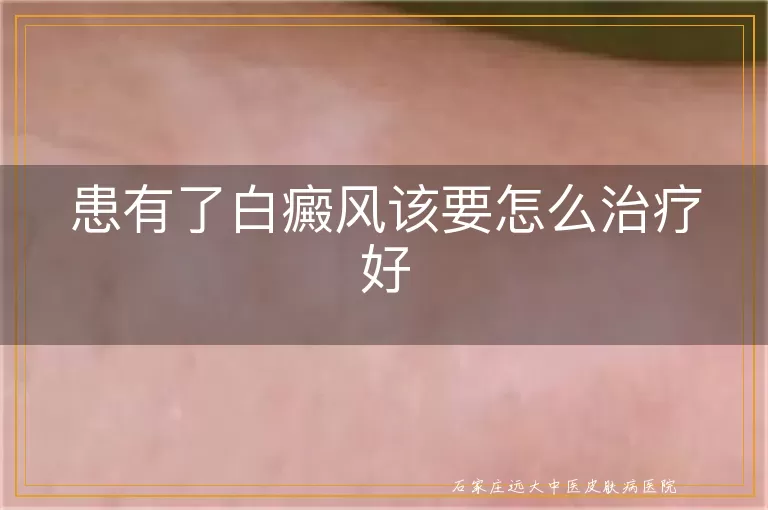 患有了白癜风该要怎么治疗好