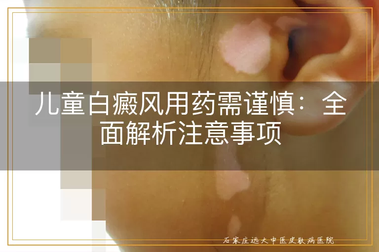儿童白癜风用药需谨慎：全面解析注意事项