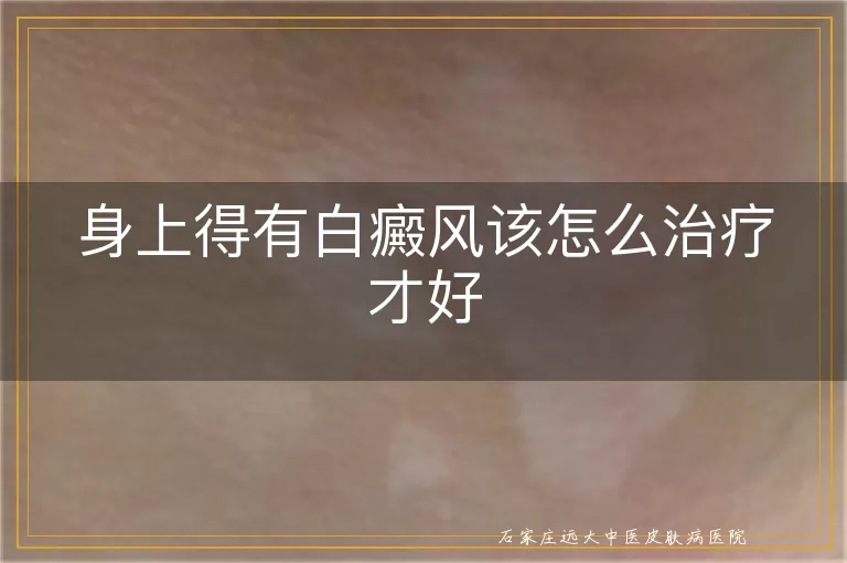 身上得有白癜风该怎么治疗才好