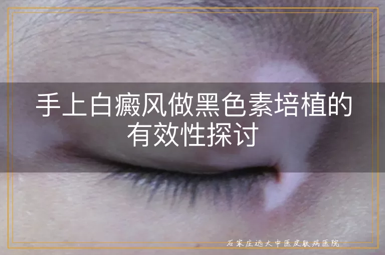 手上白癜风做黑色素培植的有效性探讨