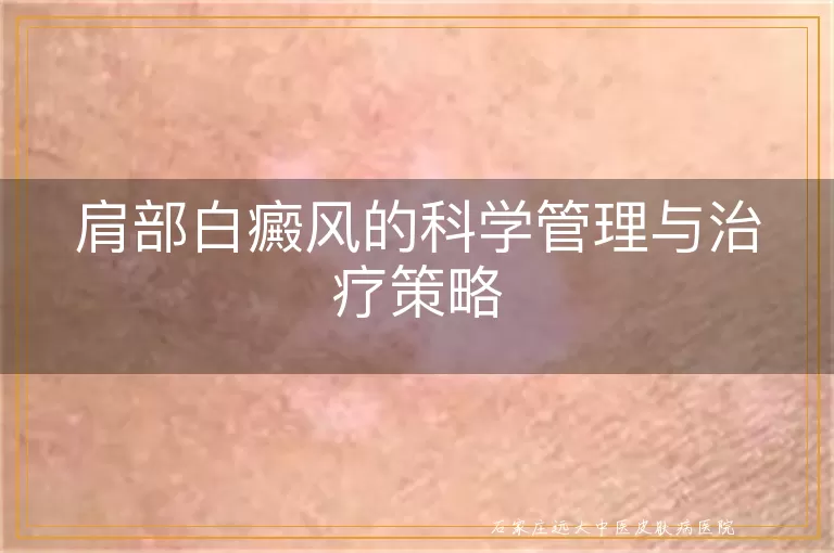 肩部白癜风的科学管理与治疗策略