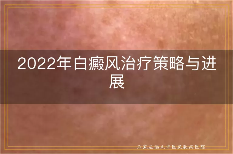 2022年白癜风治疗策略与进展