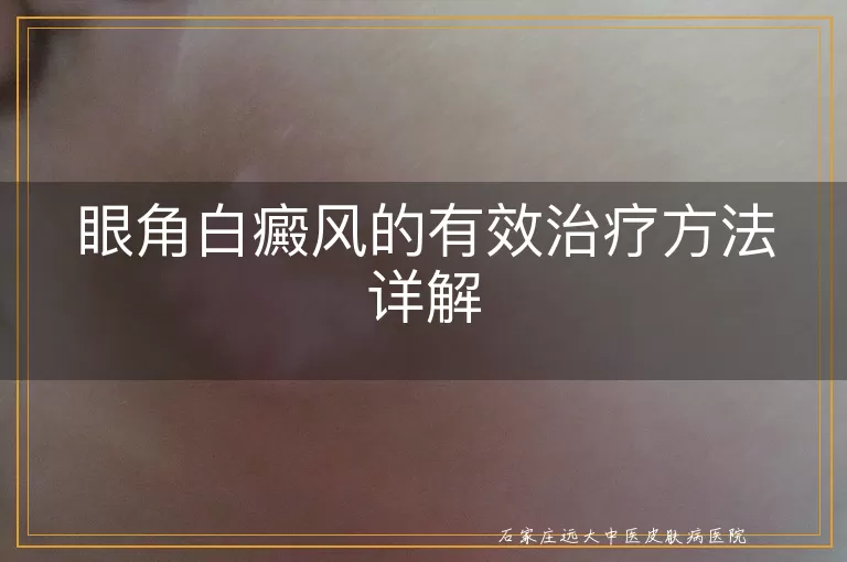 眼角白癜风的有效治疗方法详解