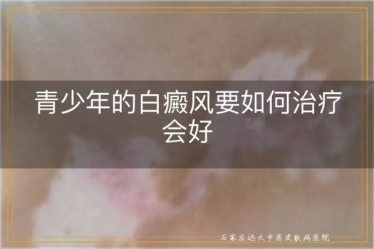 青少年的白癜风要如何治疗会好