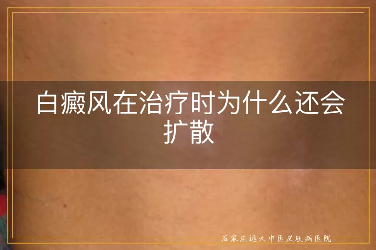 白癜风在治疗时为什么还会扩散