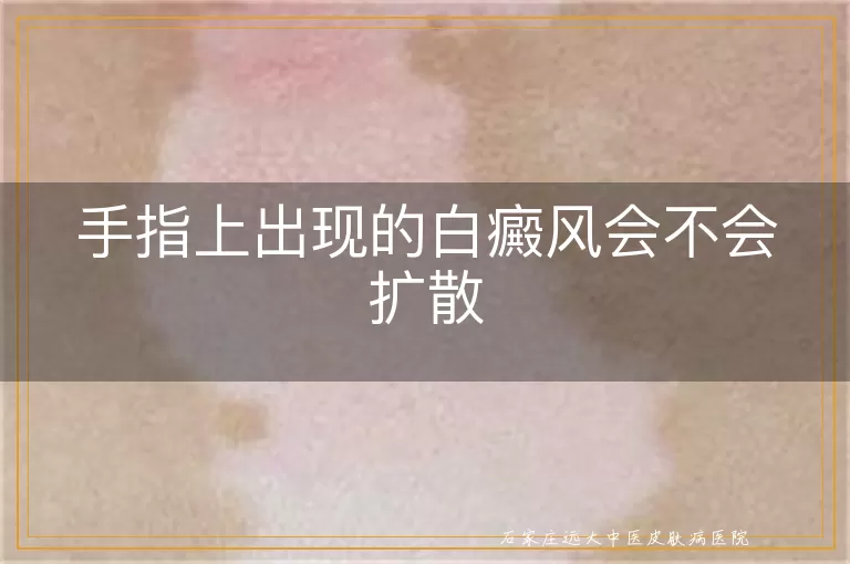 手指上出现的白癜风会不会扩散