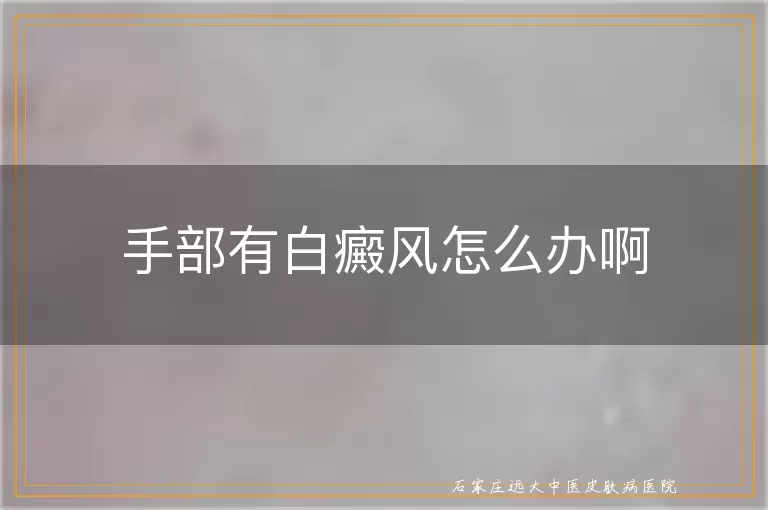 手部有白癜风怎么办啊
