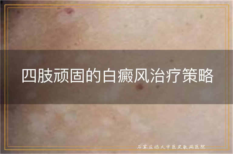 四肢顽固的白癜风治疗策略