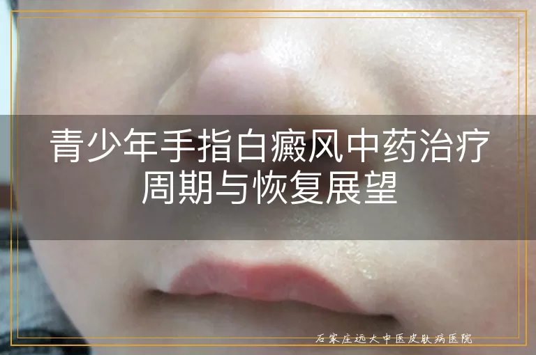 青少年手指白癜风中药治疗周期与恢复展望