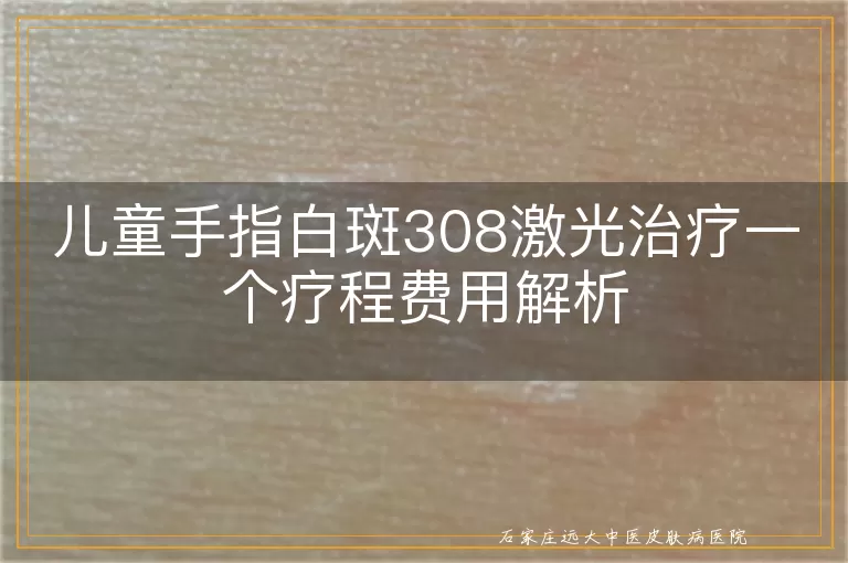 儿童手指白斑308激光治疗一个疗程费用解析
