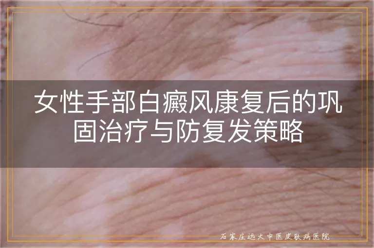 女性手部白癜风康复后的巩固治疗与防复发策略