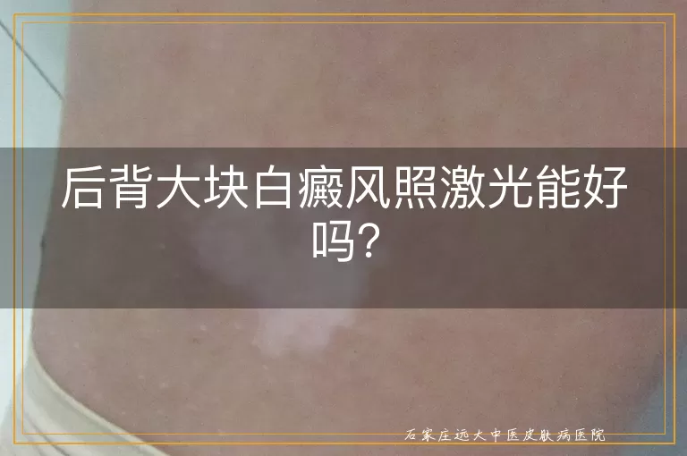后背大块白癜风照激光能好吗？