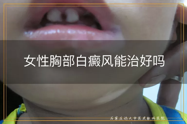 女性胸部白癜风能治好吗