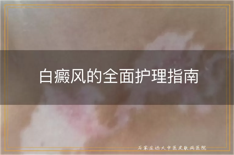 白癜风的全面护理指南
