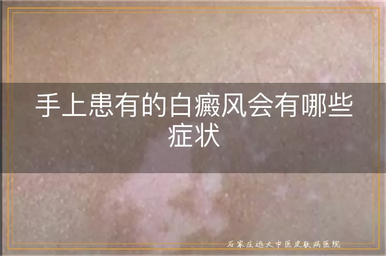 手上患有的白癜风会有哪些症状