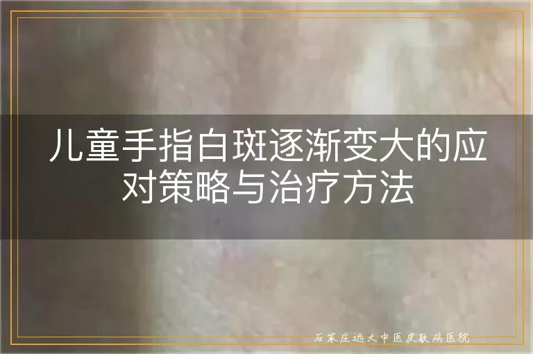 儿童手指白斑逐渐变大的应对策略与治疗方法