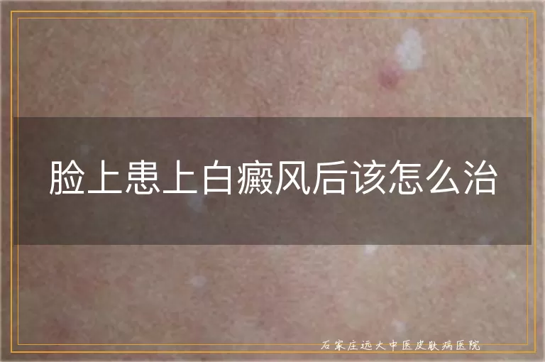脸上患上白癜风后该怎么治